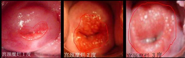 宫颈糜烂具体都有哪些症状?